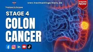 Colon Cancer Stage 4 | Bowel Cancer Stage 4 Treatments Guide
