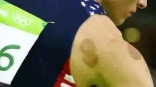 Analyzing the effectiveness of 'Cupping therapy'