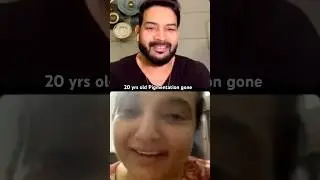 Aman&rsquo;s 20 yrs old pigmentation gone with #healthysyrusdiet