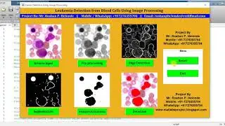 Matlab Code for Blood Cancer Leukemia Detection Using Image Processing