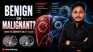 Benign vs Malignant Tumors | How to Differentiate on CT
