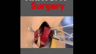 How to shoulder anatomy surgery # information for # medical students # doctor # nursing 
