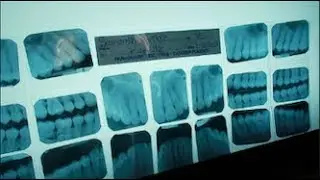 FIRST TIME GOING TO THE DENTIST IN OVER 5 YEARS!! 10 CAVITIES!!