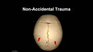 Classic Lectures in Trauma Imaging 2025 - Imaging of Traumatic Brain Injury