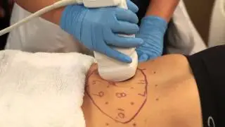 Liposonix - Permanent Fat Reduction
