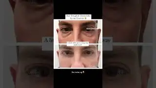 Tear Trough & Cheek filler by our Doctors 👩&zwj;⚕️