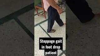 What is Steppage gait in foot drop patient? | What is foot drop gait? | high steppage gait