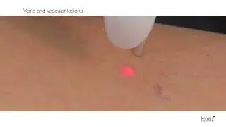 Veins and Vascular Lesions   laser removal