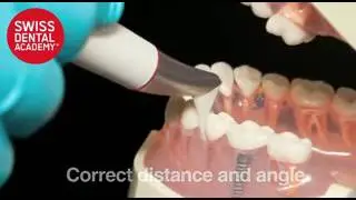 EMS PF Subgingival