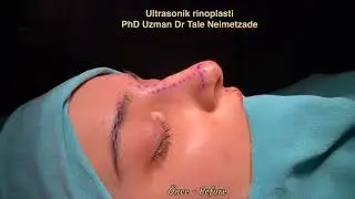 Ultrasonik rinoplasti / PhD Uzman Dr Tale Neimetzade