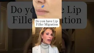 Do you have lip filler migration? #botox #beauty #filler #skincare