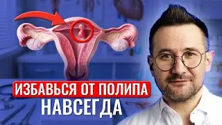 Как ПРАВИЛЬНО вылечить полип в матке? Не дайте себя обмануть