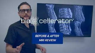 MRI Review Before & After: Stem Cell Therapy Results