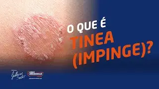 QUAIS S&Atilde;O OS TIPOS DE TINEA (IMPINGE)? | Dicas de Sa&uacute;de