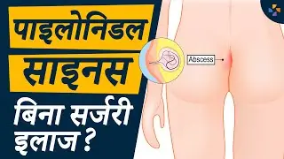 पाइलोनिडल साइनस का इलाज बिना सर्जरी? | Pilonidal Sinus Treatment Without Surgery?
