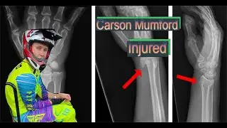 Carson Mumford Injured