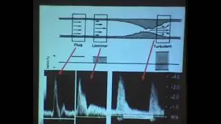 Basics of Doppler part 2   Dr Hatem El Azizi In Arabic