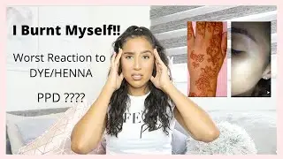 STORY TIME, I Had An Allergic Reaction To Black Henna And Hair Dye!!