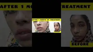 Ringworm on Face