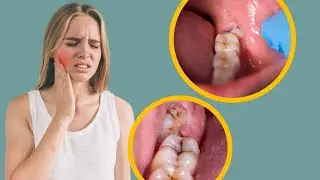 When Should Wisdom Teeth Be Removed? | Symptoms, Pain & Treatment