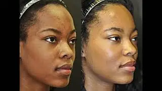 What Lower Level Peels Do We Offer: Which is Right for You - VI Peel or ZO 3-Step Peel?