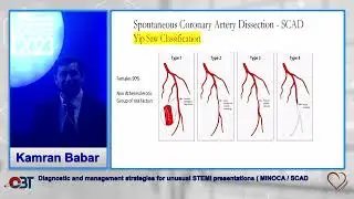 Diagnostic and management strategies for Unusual STEMI Presentation MINOCA SCAD by kamran babar