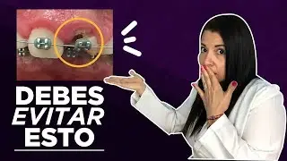 10 cosas que debes saber ANTES de usar ORTODONCIA  Joana Campolargo