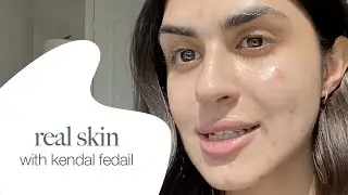Real skin with Kendal Fedail - Acne Positivity