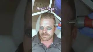 We Treated Him With the Erbium Laser for his Wrinkles, Brown Spots, and more!