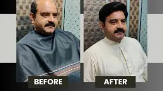 hair replacement center STAR ✨ HAIR CLUB Multan #03030825890