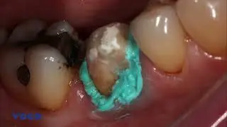 Clinical Case: 'VOCO Retraction Paste' to ensure accurate digital impressions for dental crown prep.