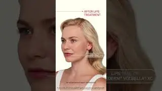 Natural Filler Results - Natural Filler Before and After - Juvederm