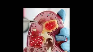 End of life care in Endstage renal disease. 