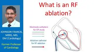 Что такое радиочастотная абляция?