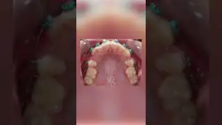 Braces Changes Timelapse of the Upper teeth with Extractions - TheBracesDoc