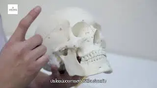 เสริมร่องแก้ม Paranasal Augmentation