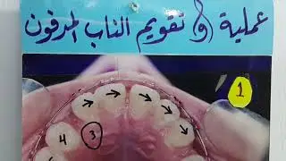 علاج الناب المطمور في سقف الفم .(حالة خاصة )