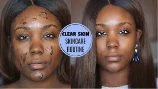 OILY SKIN ACNE SKIN CARE ROUTINE - Dark Spots / Pores to Clear Skin (DRUGSTORE 2018) - Rose Kimberly