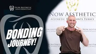 Smile Makeover: Creating Your Dream Smile Through Bonding