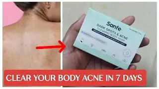 sanfe dark spots and acne clearing body soap review in Tamil #skincare