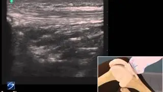How To: Ultrasound Exam of the Infra-Patellar Tendon 3D Video