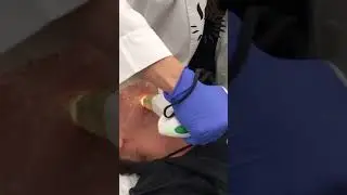 Intense Pulsed Light (IPL)