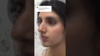 Transform your nose in minutes with NO surgery