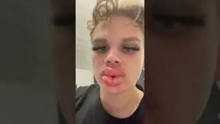 Kylie jenner lip Challenge extreme 🔥 #kyliejenner