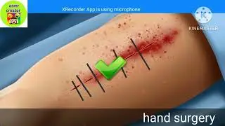 asmr animation hand surgery and liver surgery transplant #asmr #asmrvideo #asmrcommunity #satisfying