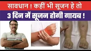 सूजन के कारण और उपचार | Ankle Swelling, Leg Swelling causes & Treatment In Hindi