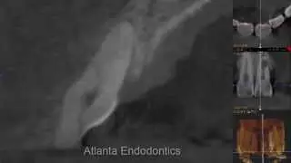 Mapping Internal Resorption