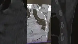 Отсумкованный плеврит на КТ.