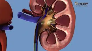 MMRV Hospital - Surprising facts about kidney stones | Best Removal Kidney Stones Hospitals Chennai