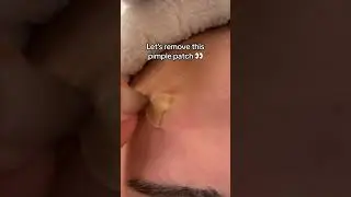 Let&rsquo;s take off this pimple patch 👀😍 #pimplepatch #acneproneskin #pimplesolution #acne
